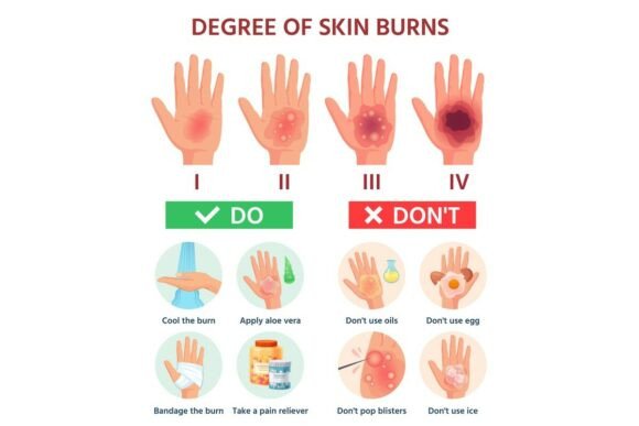 First Aid for Burn Wounds: Understanding Burns Degree and Proper Treatment