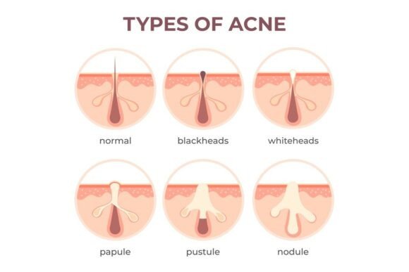 Understanding Acne Types Anatomy: Pimple Diseases and Their Impact on Skin Health